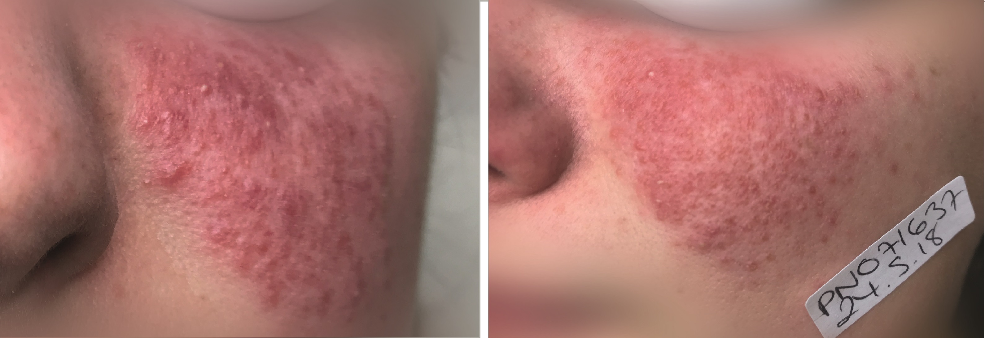 Papulopustar (inflammatory) rosacea